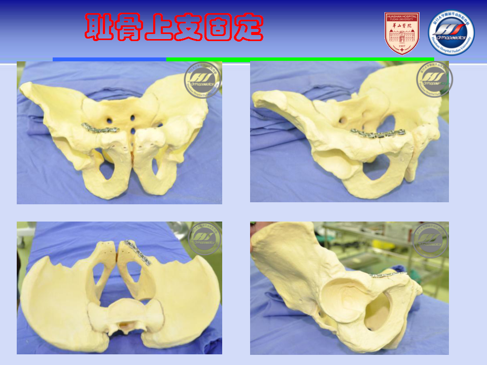 骨盆髋臼骨折内固定植入技巧，全面分析！