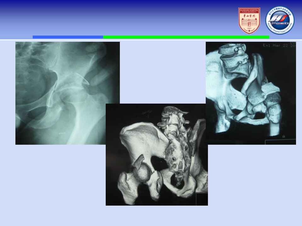 骨盆髋臼骨折内固定植入技巧，全面分析！