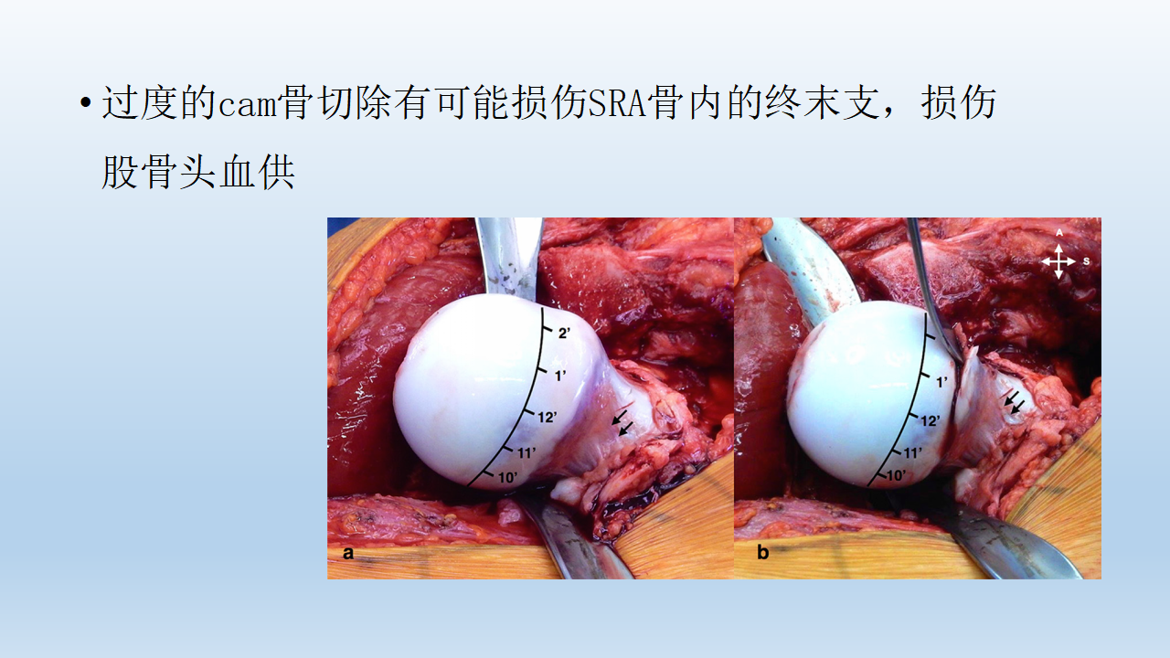 关于股骨头血供，这篇课件讲得太全面了！