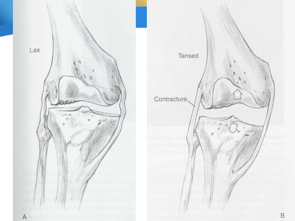 如何做好膝关节置换术中下肢力线与软组织平衡？
