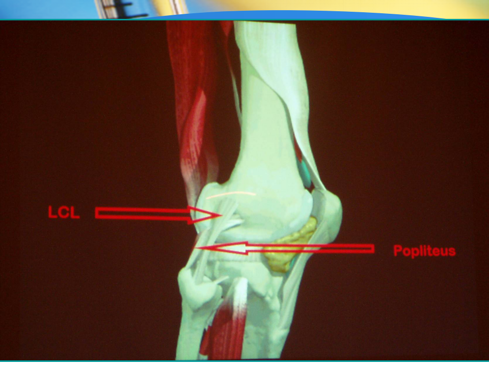 如何做好膝关节置换术中下肢力线与软组织平衡？
