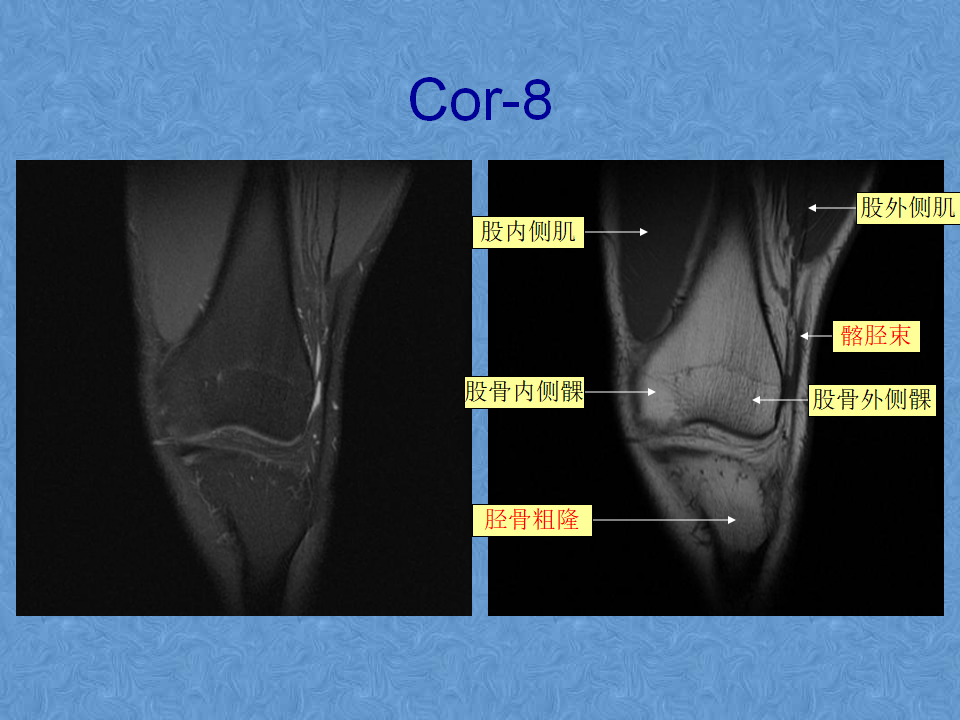 膝关节MRI高清解剖图解，值得收藏！