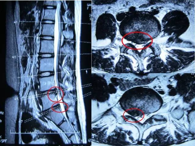 腰椎间盘突出症的分型及治疗策略
