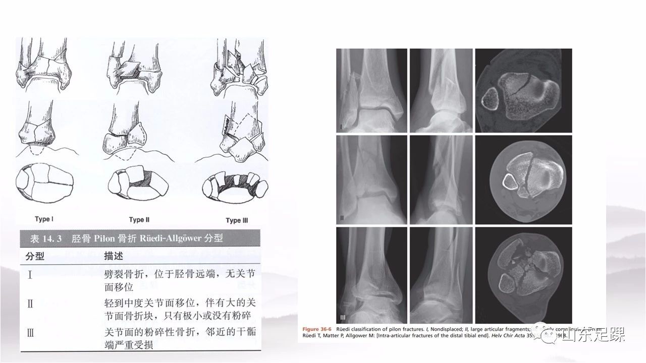 一篇掌握：后踝骨折的诊断与分型