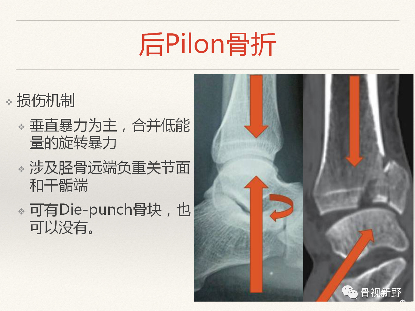 手术技巧：经踝管入路治疗后Pilon骨折