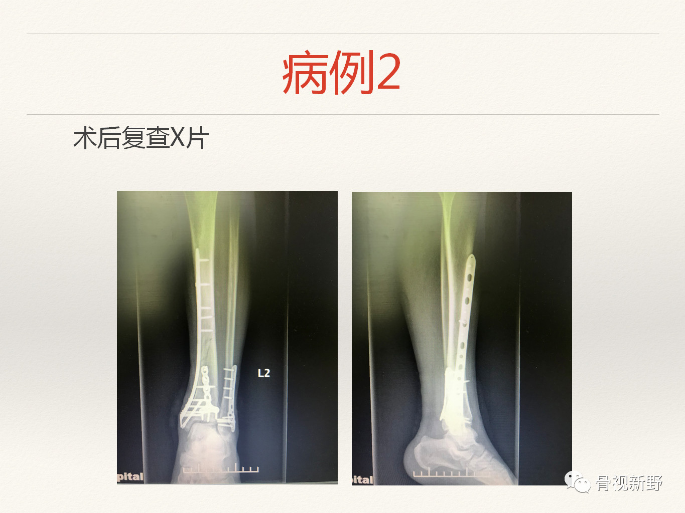 手术技巧：经踝管入路治疗后Pilon骨折