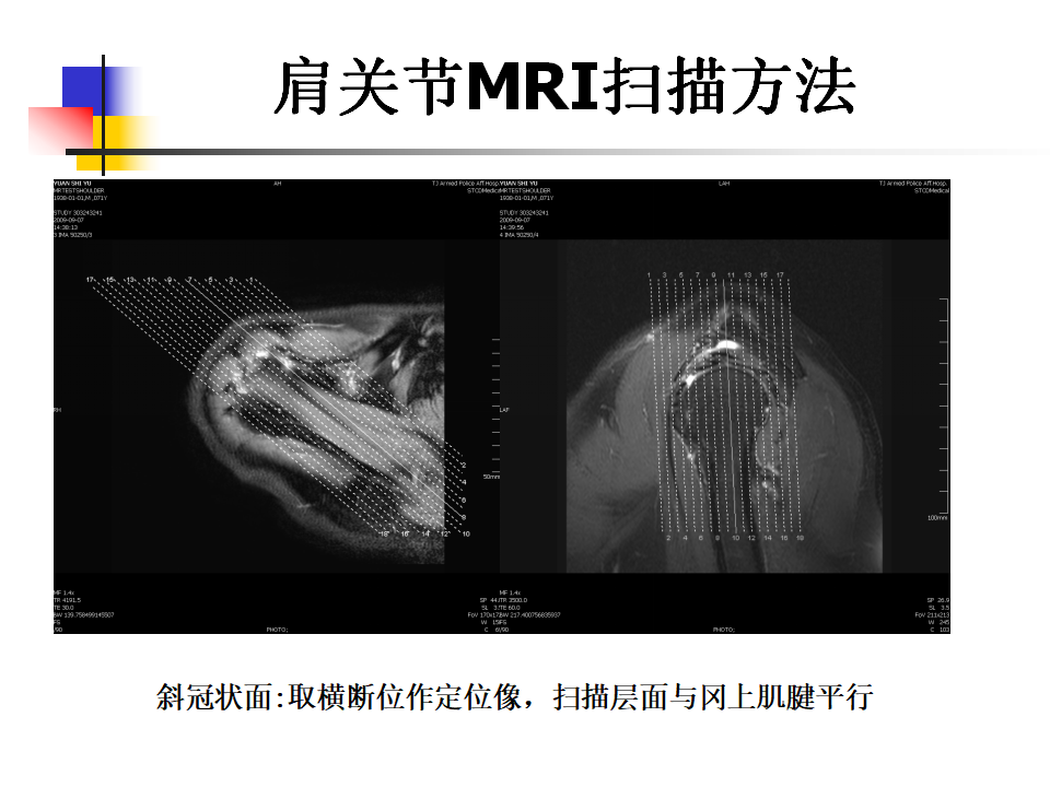 肩关节病变MRI解剖及诊断，值得收藏！