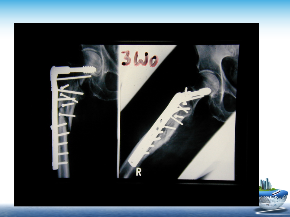 微创技术在创伤骨科中的应用，全面总结！