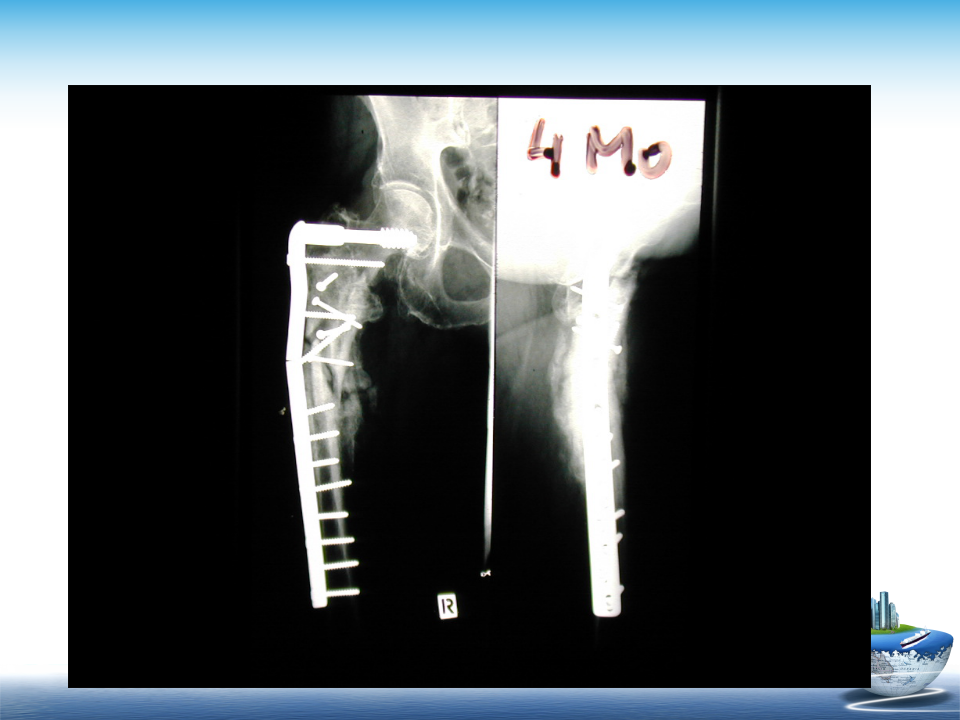 微创技术在创伤骨科中的应用，全面总结！