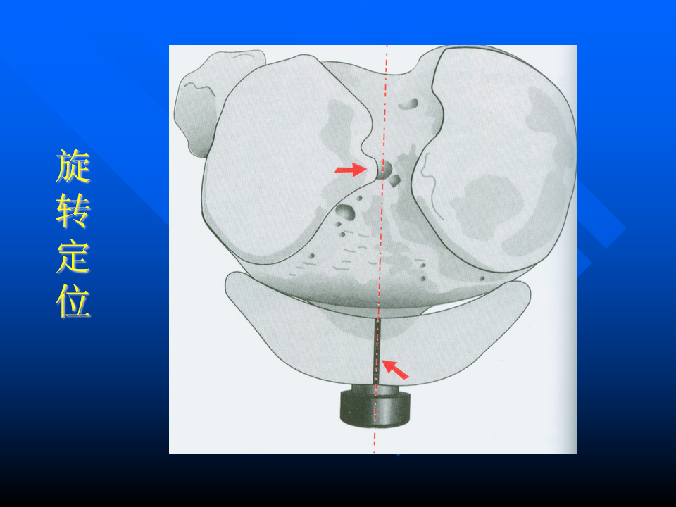 初次人工全膝关节置换术实用技巧，都在这里！