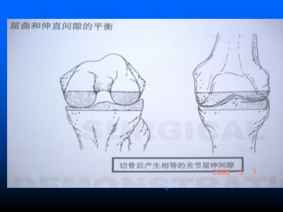 初次人工全膝关节置换术实用技巧，都在这里！