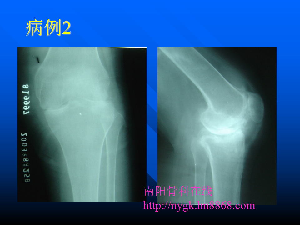 初次人工全膝关节置换术实用技巧，都在这里！