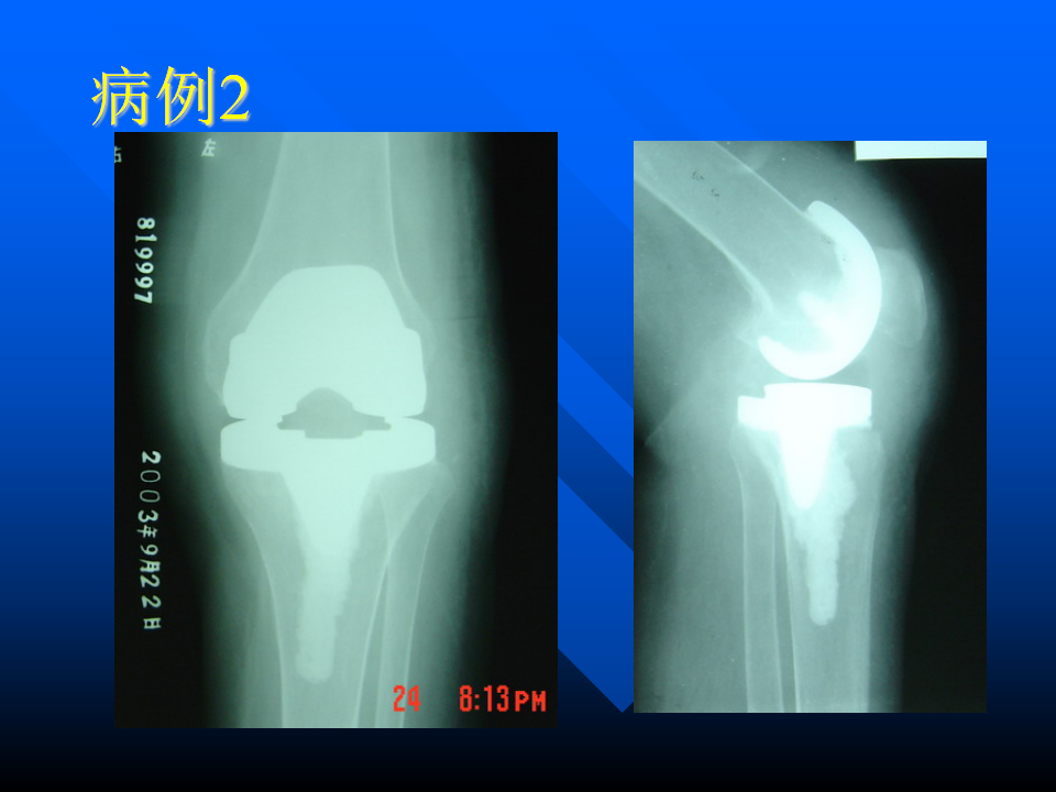 初次人工全膝关节置换术实用技巧，都在这里！