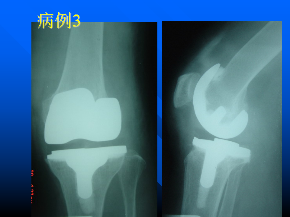 初次人工全膝关节置换术实用技巧，都在这里！