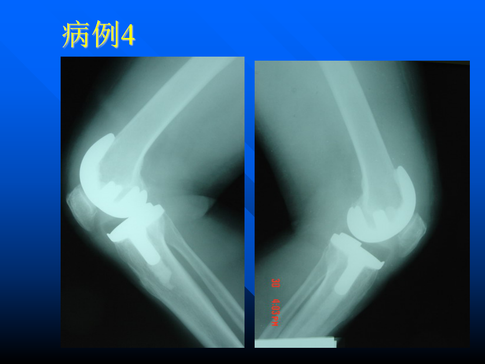 初次人工全膝关节置换术实用技巧，都在这里！