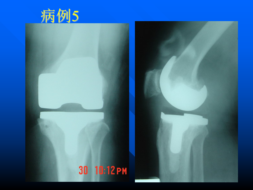 初次人工全膝关节置换术实用技巧，都在这里！