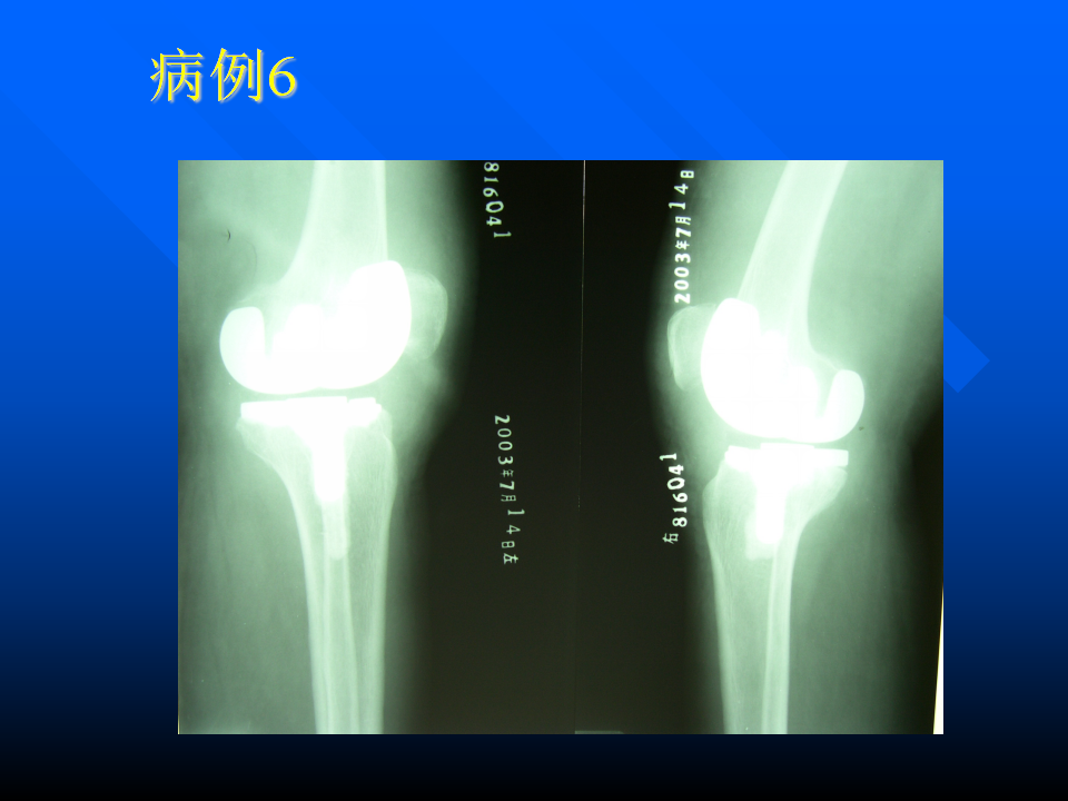 初次人工全膝关节置换术实用技巧，都在这里！