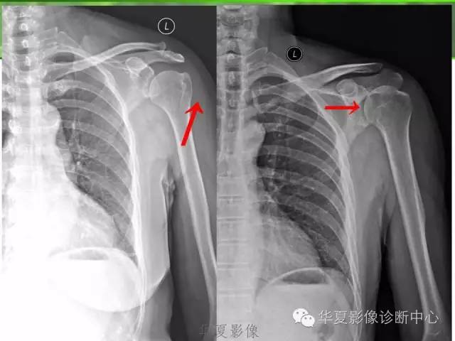 X线片怎么诊断肩周炎？看看这篇
