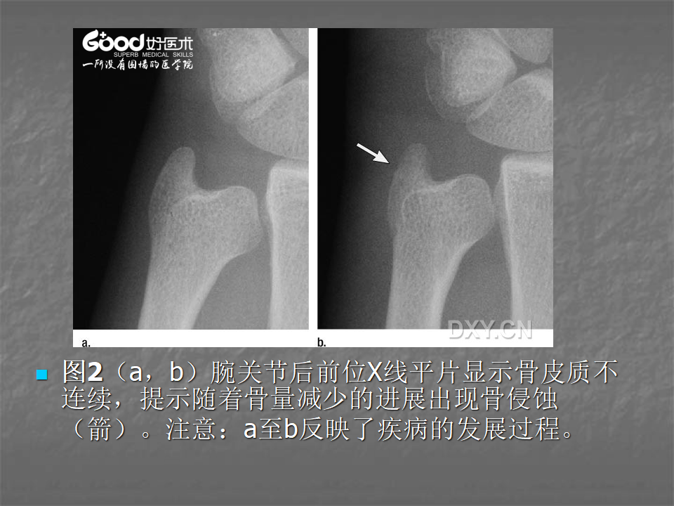 关节炎的X线评价，太全面了！