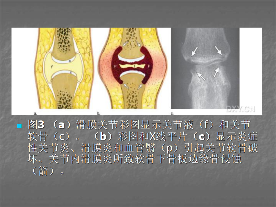 关节炎的X线评价，太全面了！