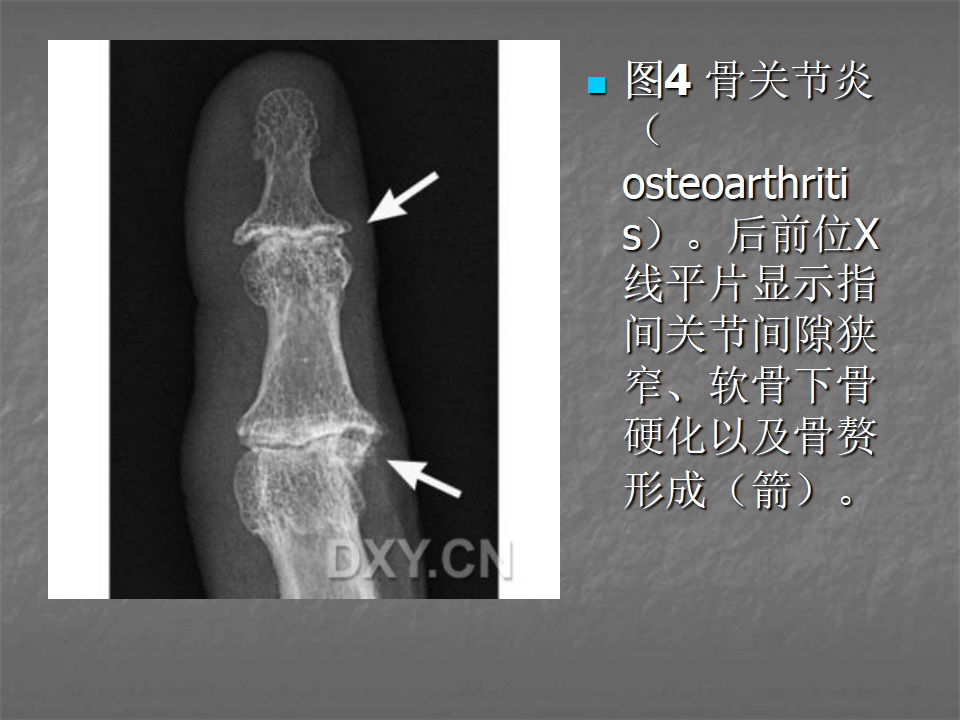 关节炎的X线评价，太全面了！