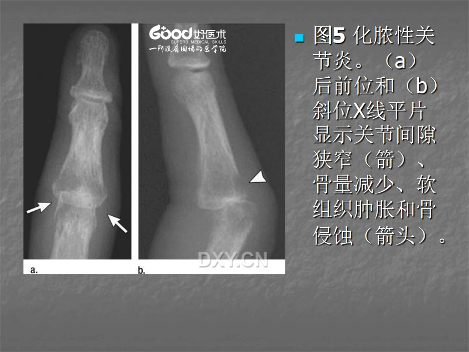 关节炎的X线评价，太全面了！