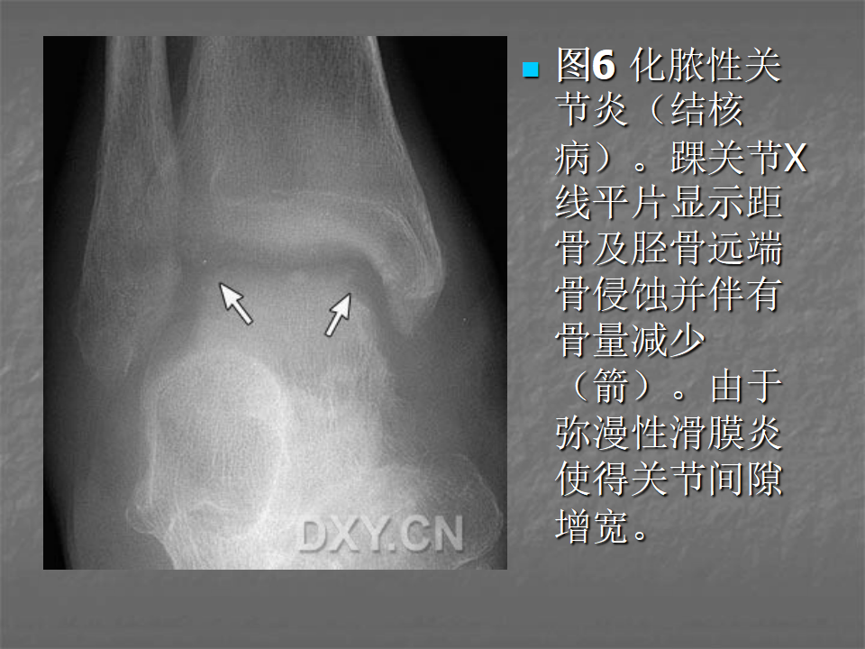 关节炎的X线评价，太全面了！