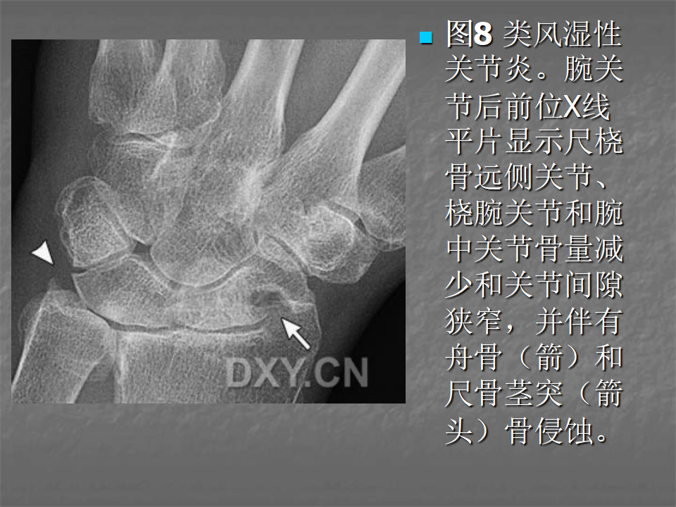 关节炎的X线评价，太全面了！