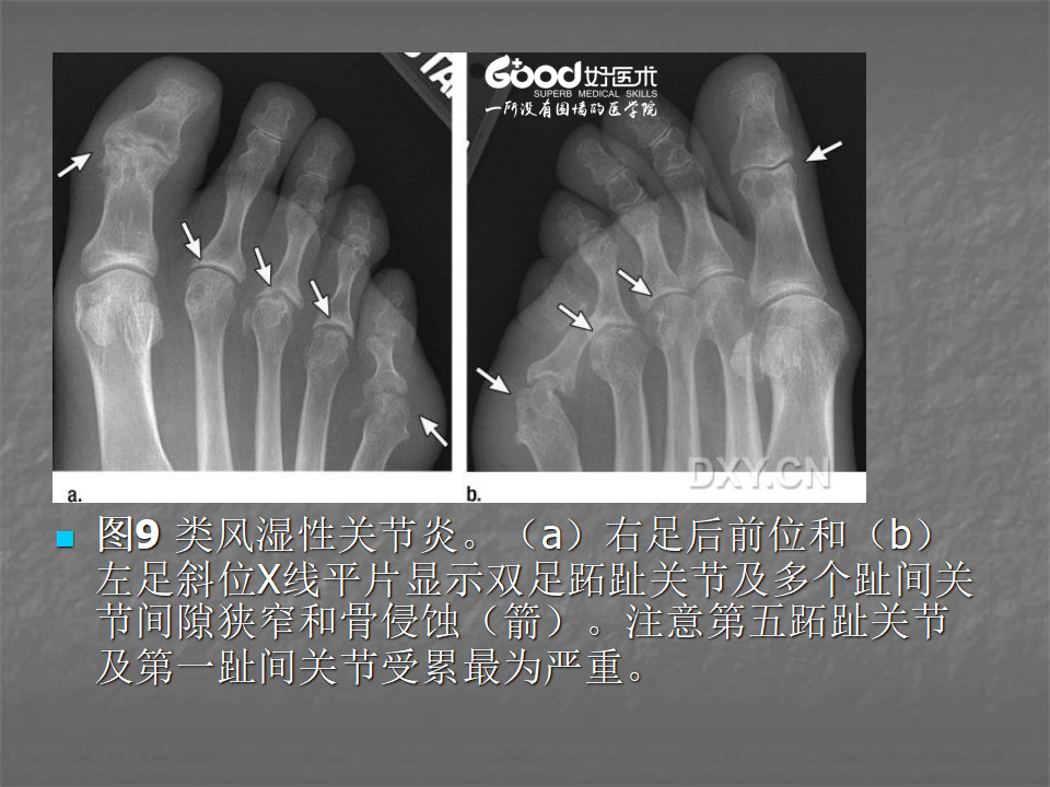 关节炎的X线评价，太全面了！