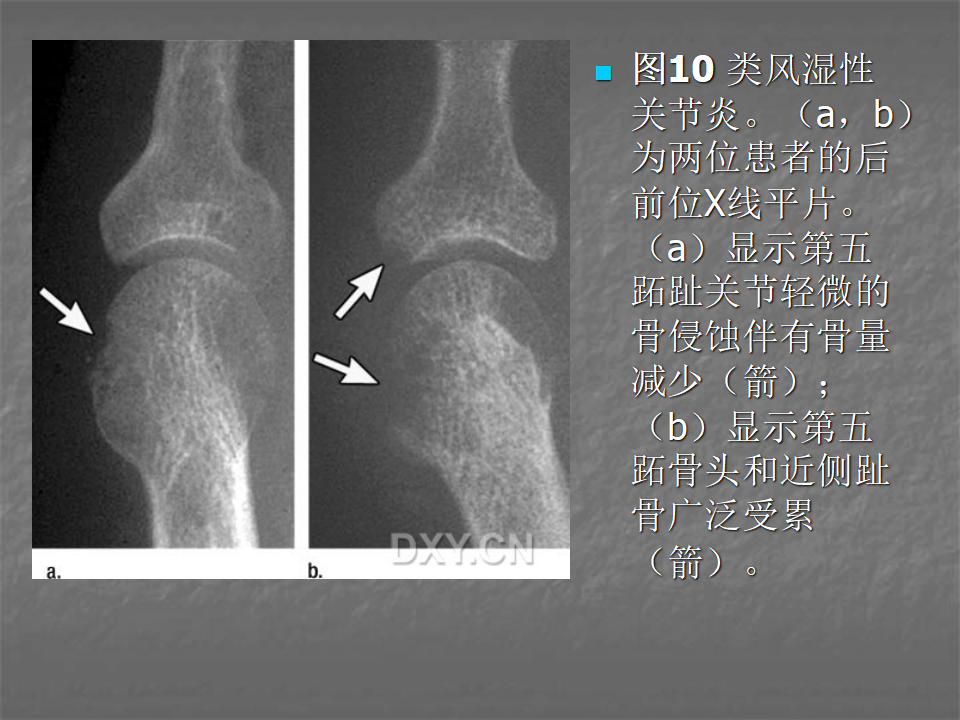 关节炎的X线评价，太全面了！