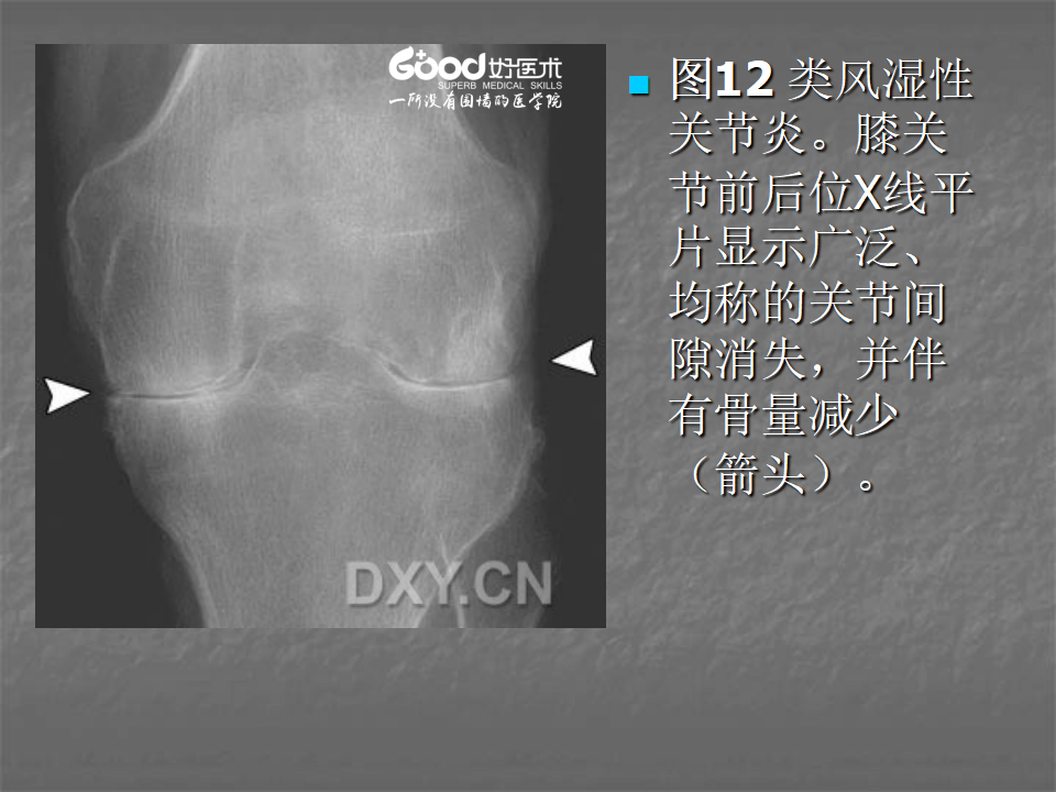 关节炎的X线评价，太全面了！