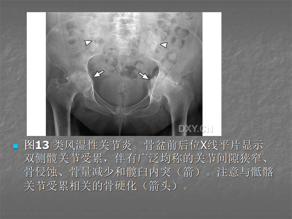 关节炎的X线评价，太全面了！