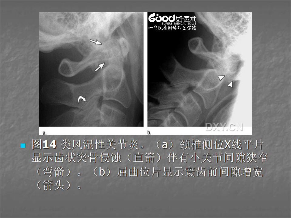 关节炎的X线评价，太全面了！