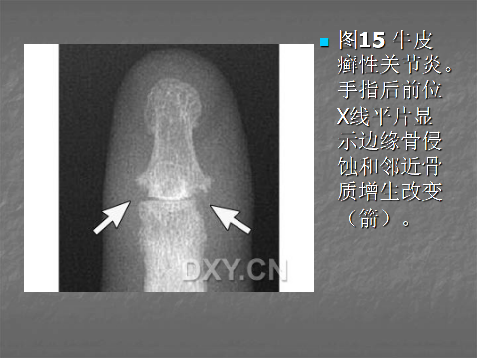 关节炎的X线评价，太全面了！