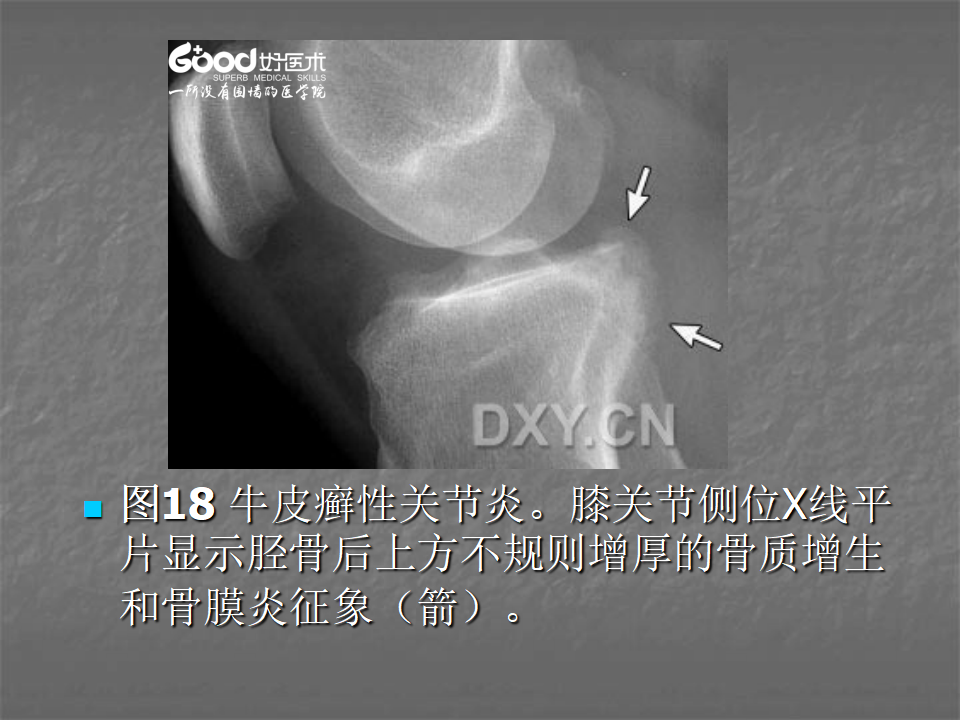 关节炎的X线评价，太全面了！