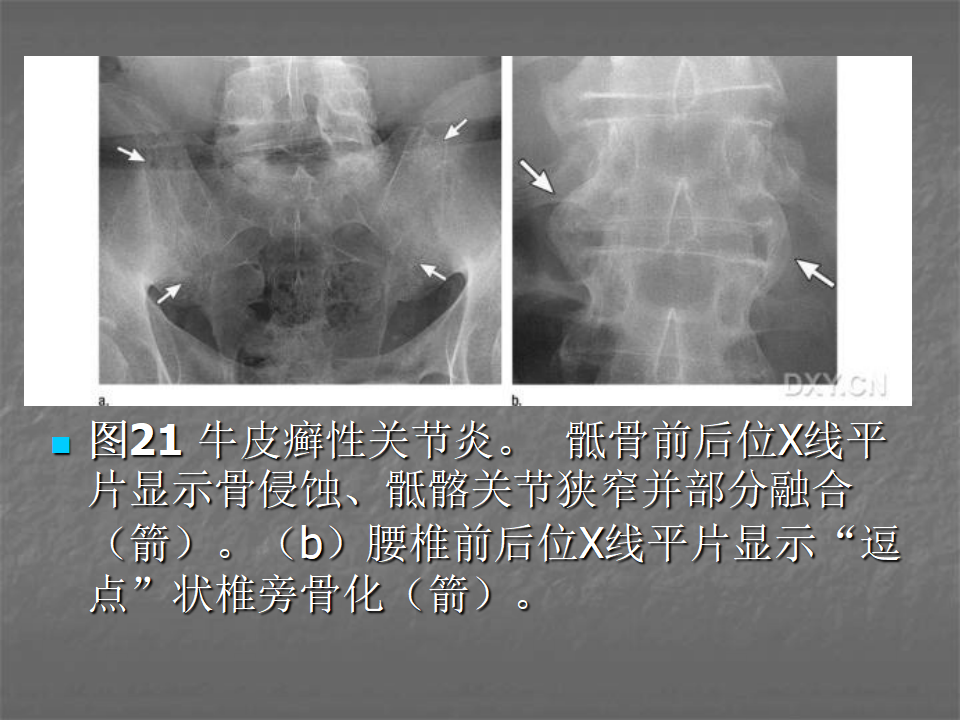 关节炎的X线评价，太全面了！