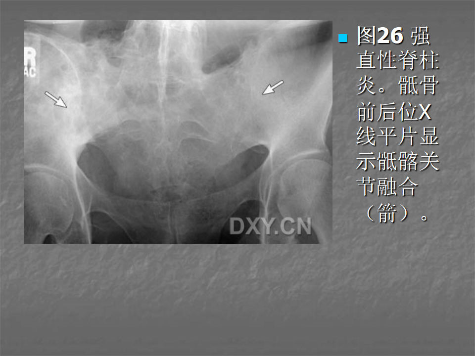 关节炎的X线评价，太全面了！