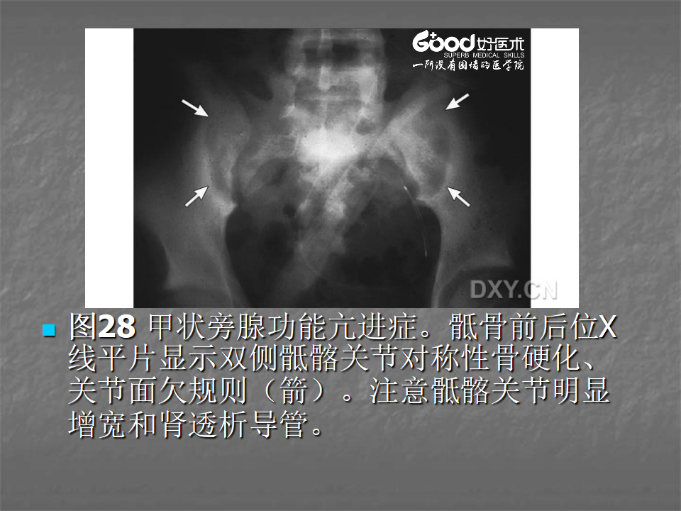 关节炎的X线评价，太全面了！