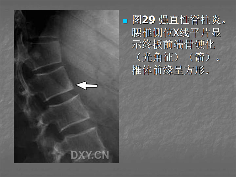 关节炎的X线评价，太全面了！