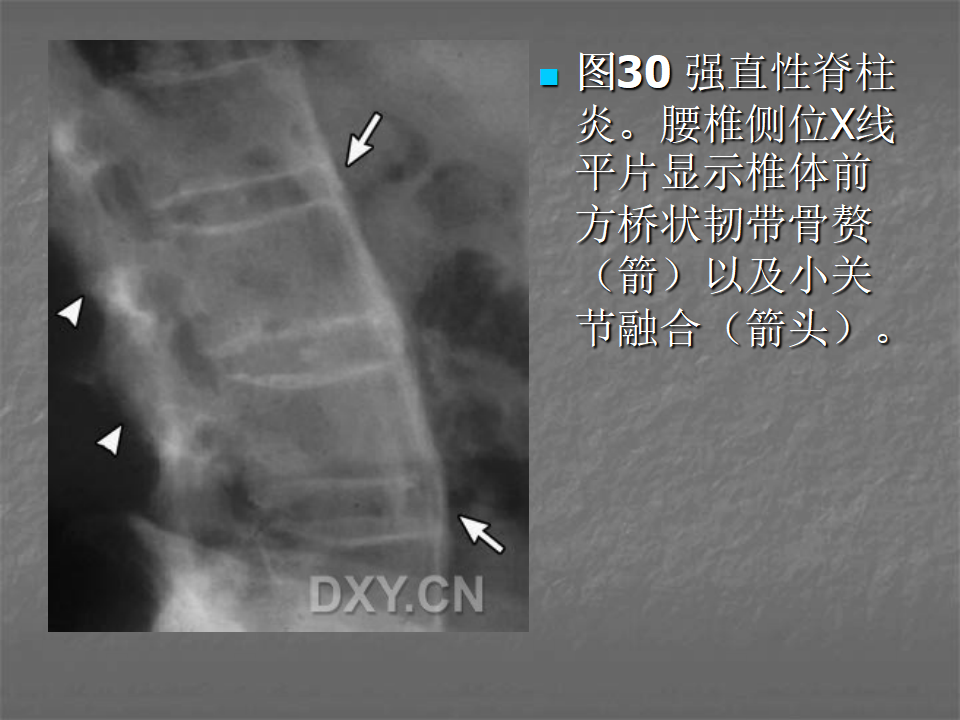 关节炎的X线评价，太全面了！