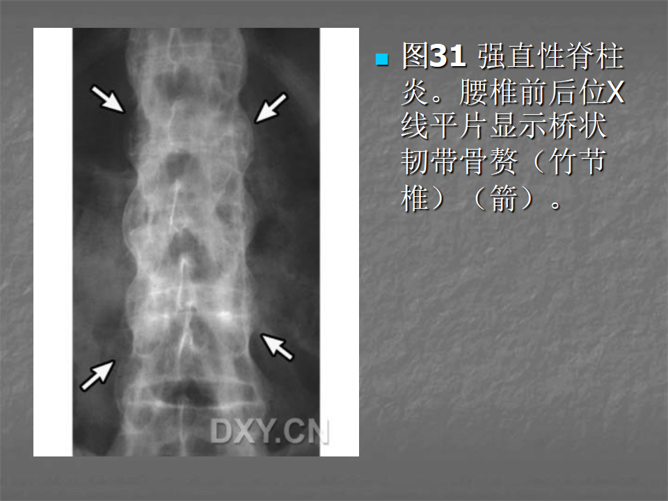 关节炎的X线评价，太全面了！