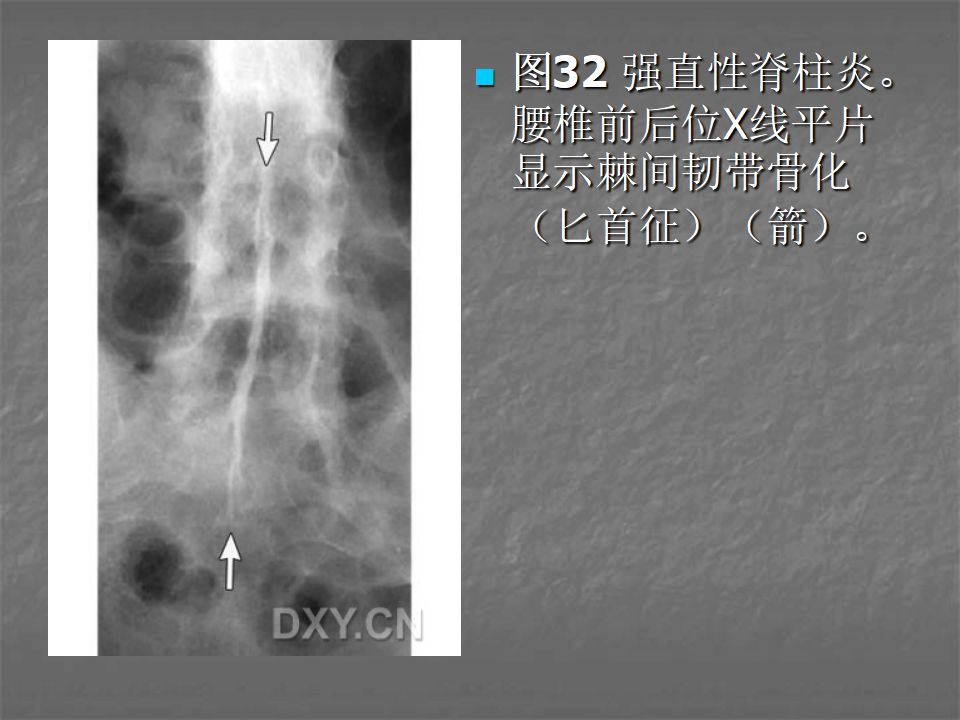 关节炎的X线评价，太全面了！