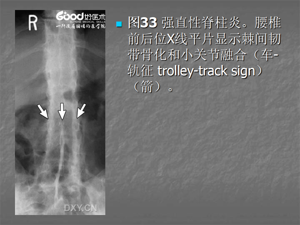 关节炎的X线评价，太全面了！