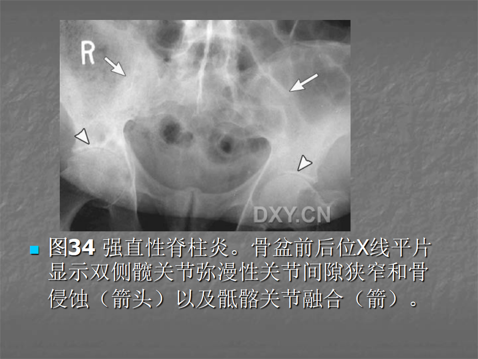 关节炎的X线评价，太全面了！