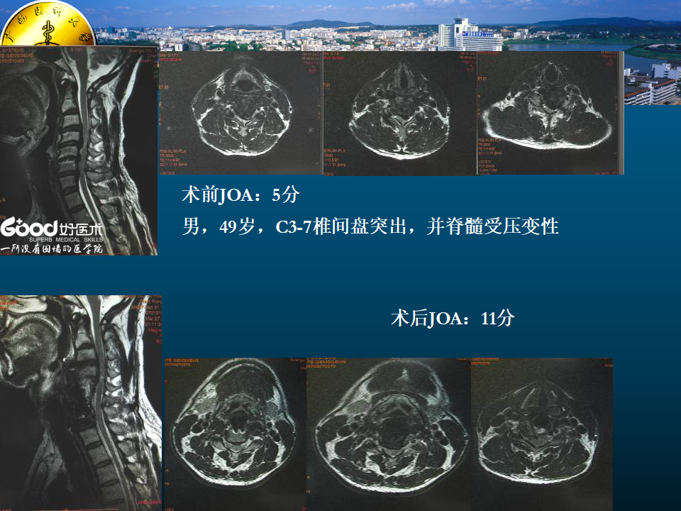 一篇课件详解：颈椎病的MRI诊断技巧！