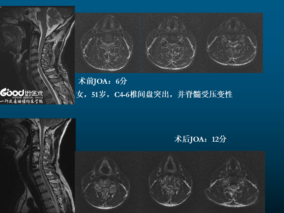 一篇课件详解：颈椎病的MRI诊断技巧！