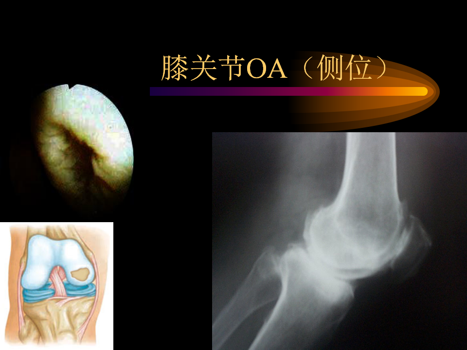 膝关节骨性关节炎的阶梯治疗策略，看这里！