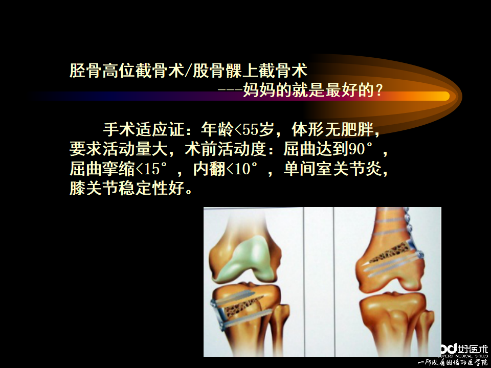 膝关节骨性关节炎的阶梯治疗策略，看这里！
