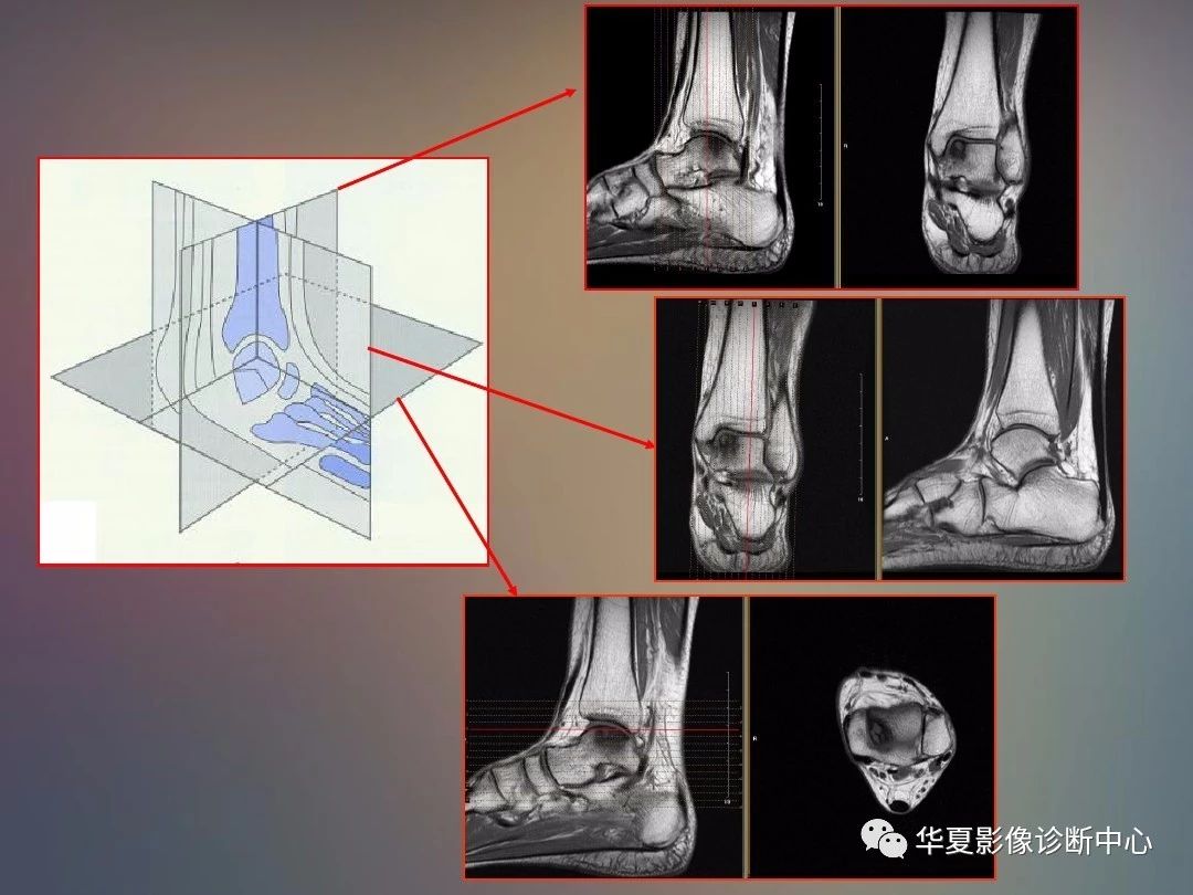 踝关节MRI读片要点，对你或许会有帮助！