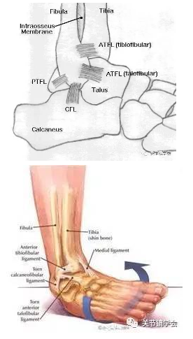 踝关节扭伤的诊断及治疗方法，看这篇就够了！